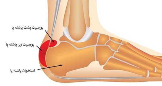 علائم درد پاشنه در پای چپ و راست