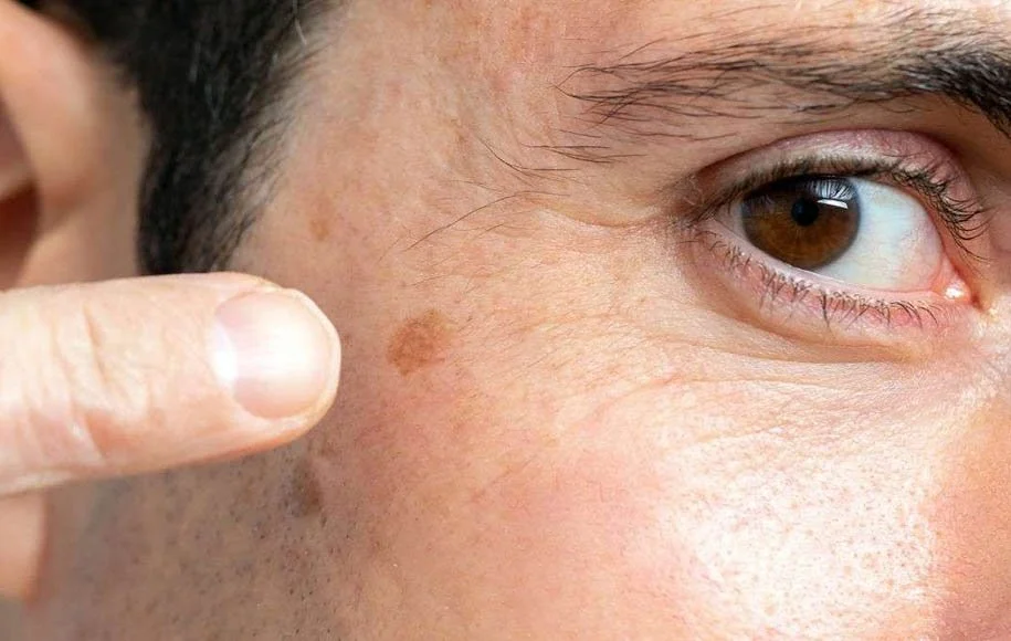  چطور از ایجاد لک جدید جلوگیری کنیم؟