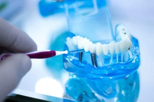 چطور ایمپلنت را تمیز کنیم؟