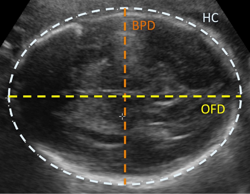 اهمیت اندازه گیری BPD با استفاده از سونوگرافی چیست؟