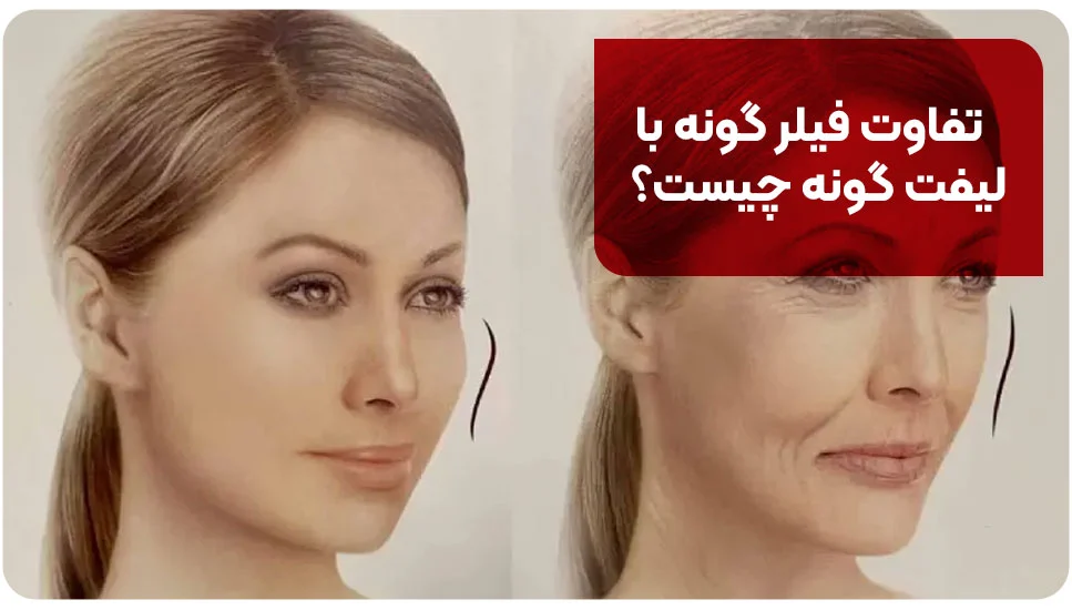 تفاوت فیلر گونه با لیفت گونه چیست؟